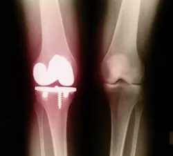 ResizedImage350317-bone-health ResizedImage350317-bone-health